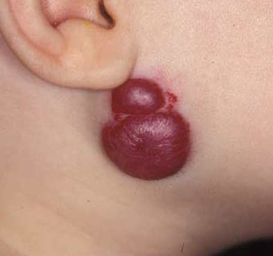 Advice for Parents Regarding Hemangiomas:  Time to change our approach in Pediatrics?