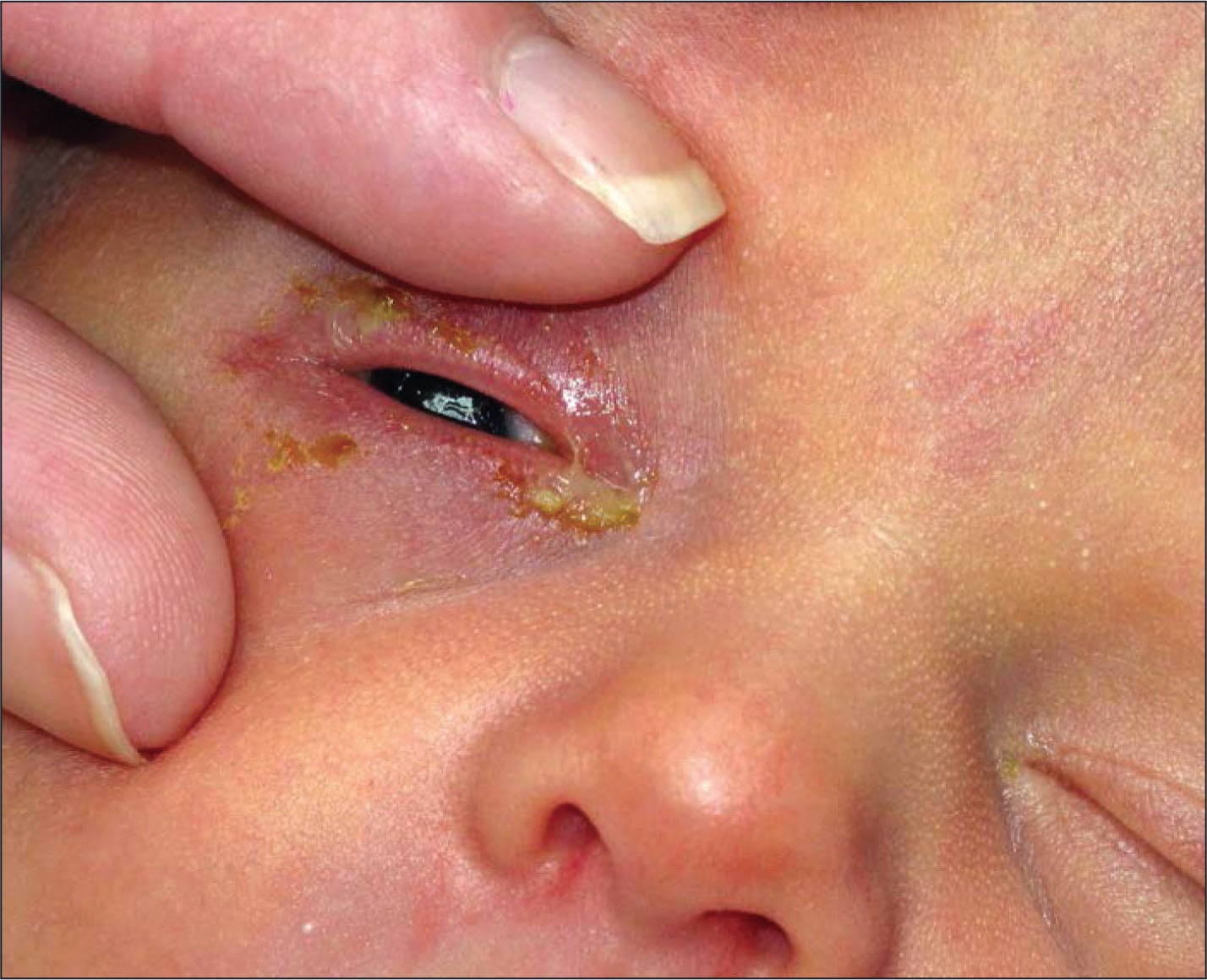 Do Newborns Still Need Ocular Erythromycin Prophylaxis After Delivery?