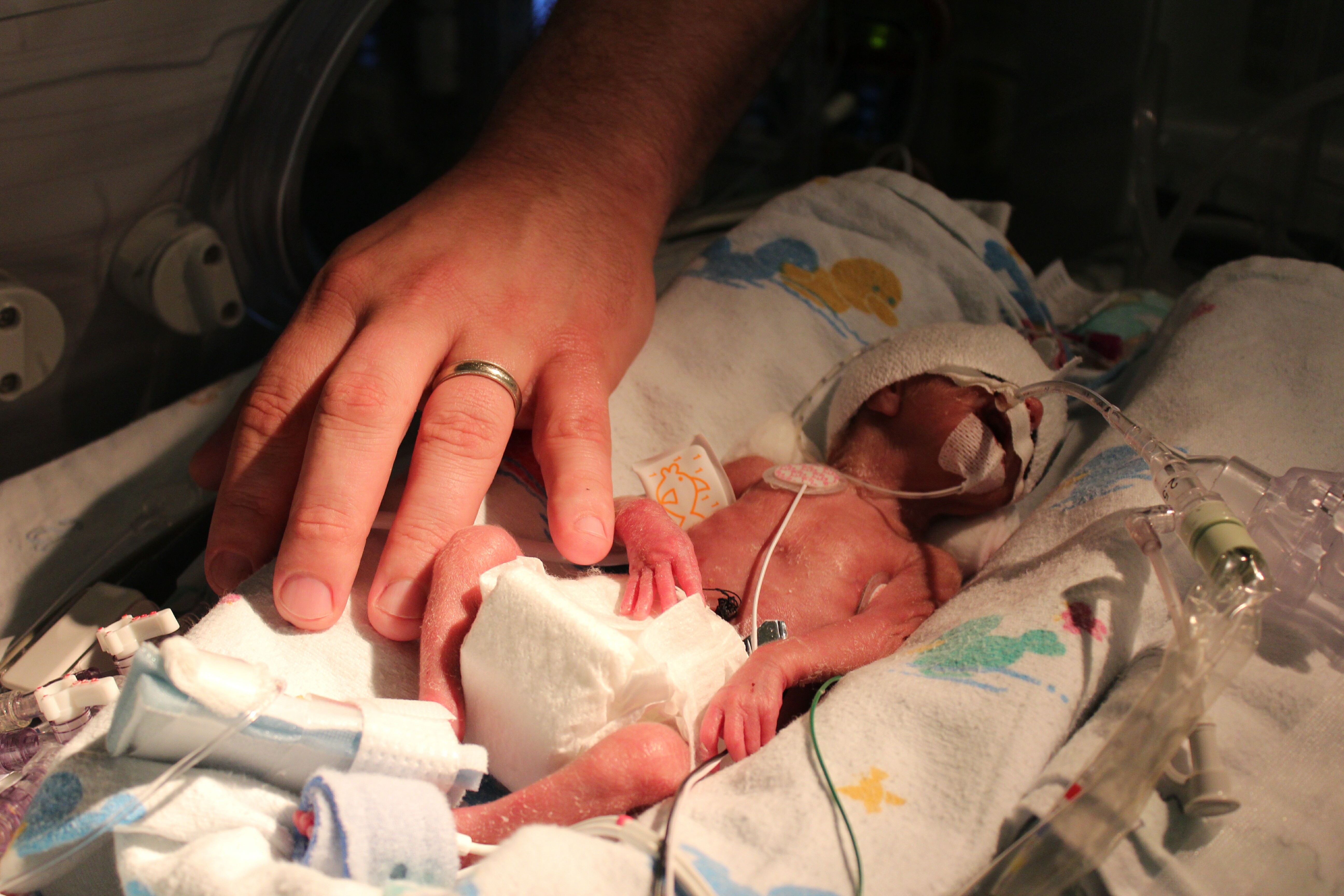 Could Shielding TPN From Light Save Your Preemie's Life?
