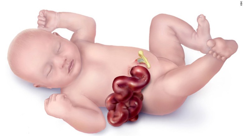 Is Cannabis To Blame For The Rise In Rates of Gastroschisis?