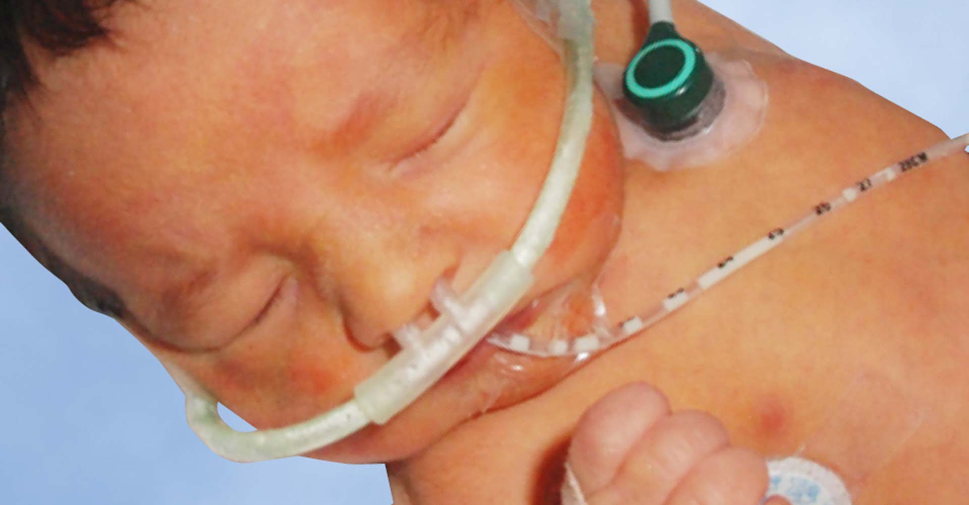 High Flow Nasal Cannula: Be Careful Out There