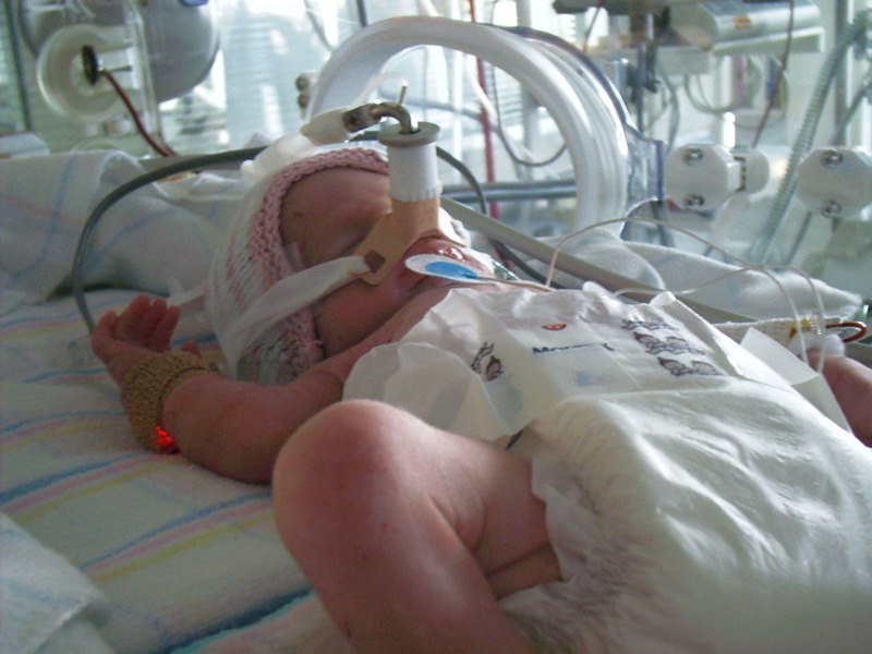 Is our approach to ventilation harming babies?