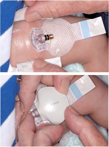 Continuous glucose monitoring in NICU may be around the corner