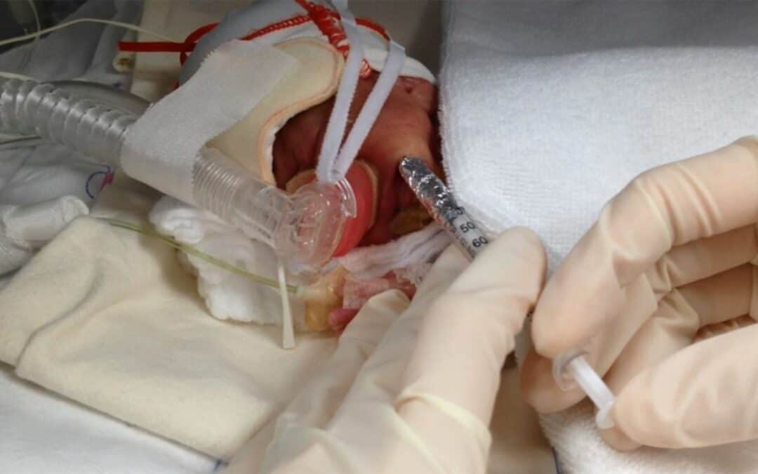 Does oral immune therapy with colostrum prevent late onset sepsis in preterm infants?